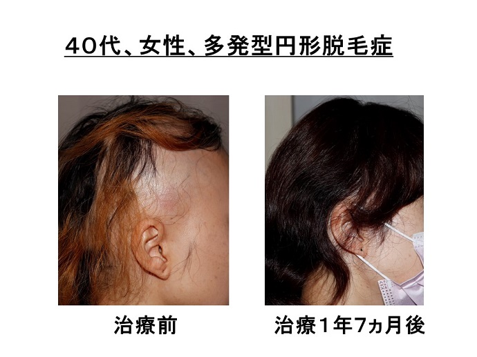 円形脱毛症　病院